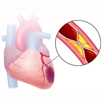 Τριγλυκερίδια και ανάπτυξη καρδιαγγειακών παθήσεων